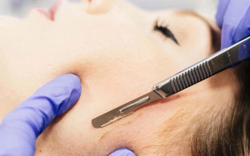 Lợi ích của việc cạo lông mặt