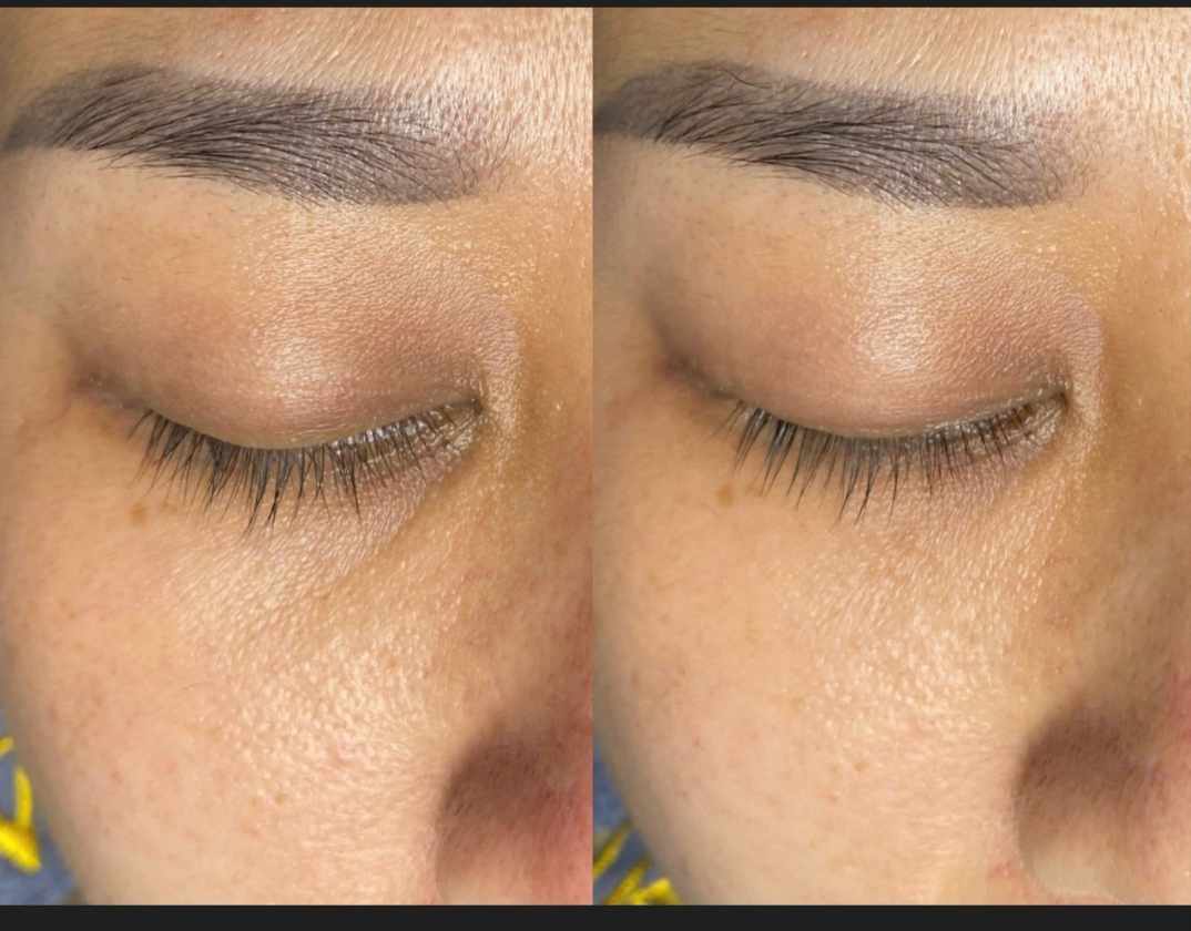 massage mắt