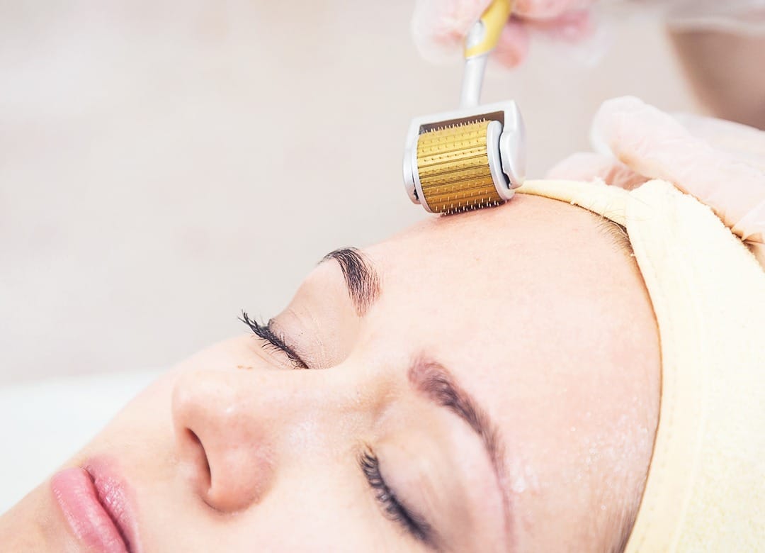 Microneedling (Lăn Kim)