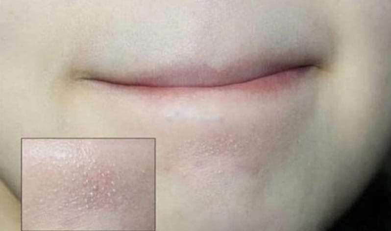 Mụn ẩn dưới cằm là gì?