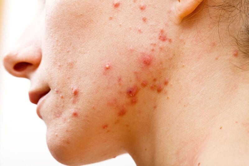 Mụn bọc là gì?