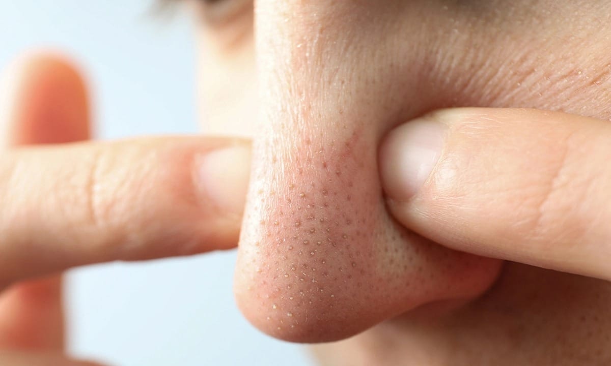 Mụn bọc và mụn đầu đen xuất hiện ở vùng mũi