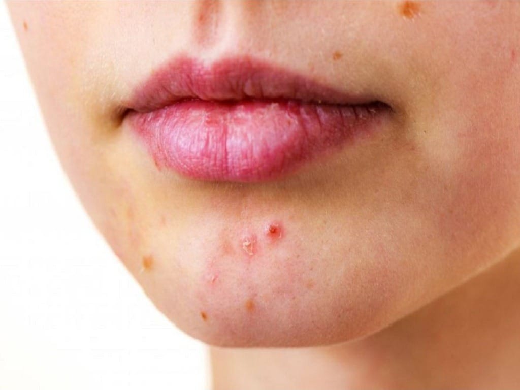 Mụn bọc và mụn trứng cá thường xuất hiện nhiều ở khu vực cằm