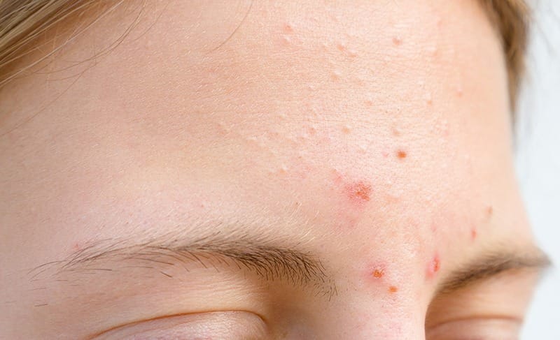 Mụn nổi ở vùng trán