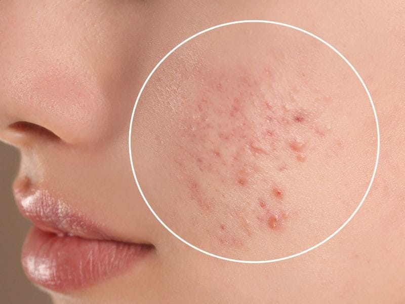 Mụn ở má là hiện tượng phổ biến