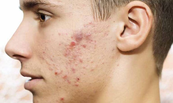 Mụn phát sinh ở gò má là dấu hiệu cảnh báo liên quan đến đường ruột