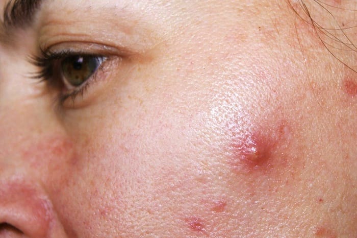 What is a red pimple?