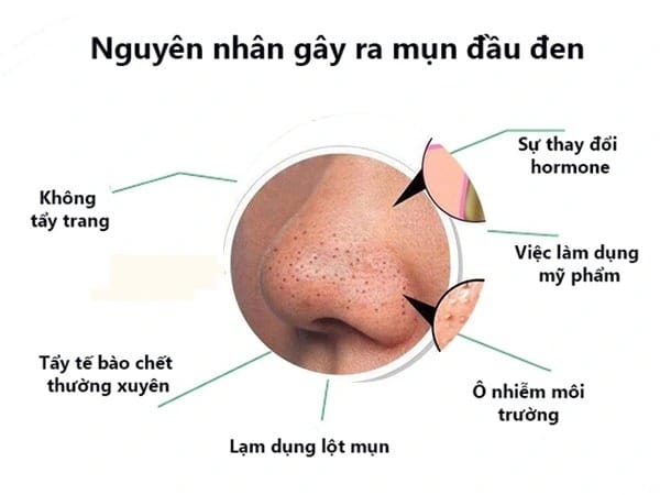 Nguyên nhân gây mụn đầu đen ở mũi