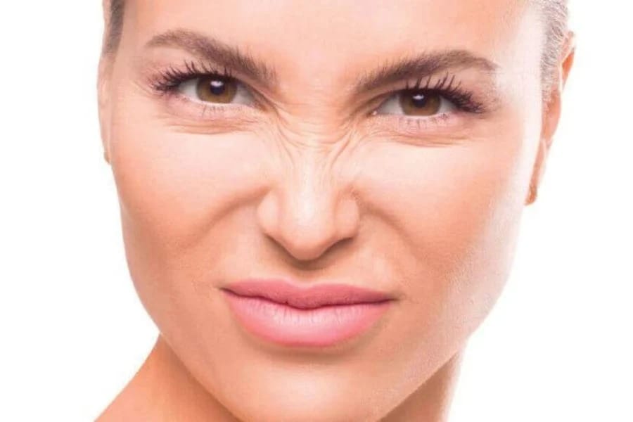 Nguyên nhân gây ra nếp nhăn sống mũi