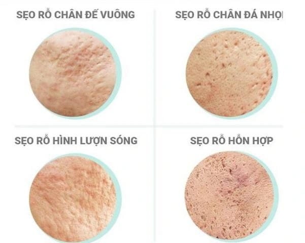 Nguyên nhân gây ra sẹo rỗ
