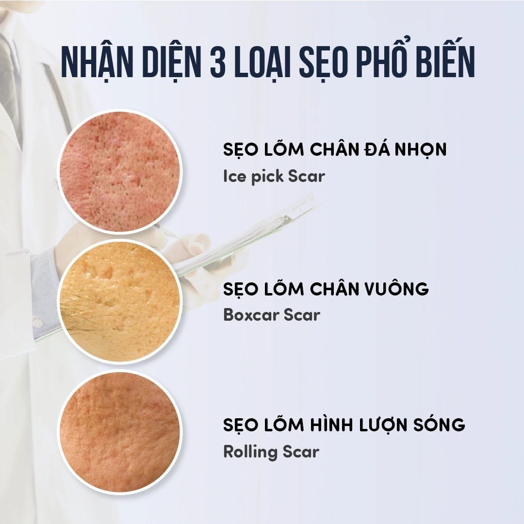 Nhận diện 3 loại sẹo lõm phổ biến