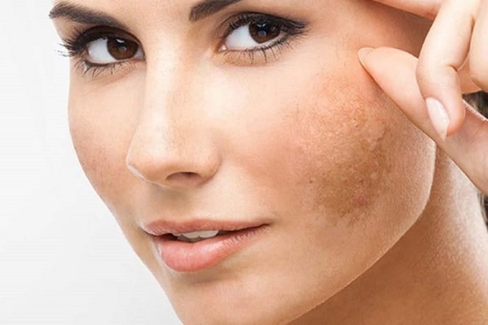 Who Should Consider Laser Treatment for Melasma?