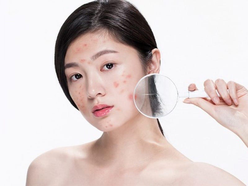 Những điều cần chú ý khi mụn xuất hiện ở các vị trí khác nhau trên mặt