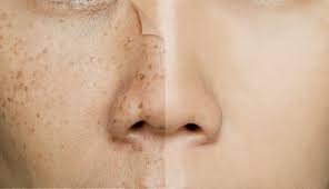Những lưu ý khi áp dụng các cách giảm melanin