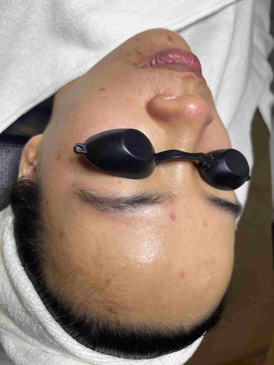Peeling hóa học (Chemical Peels)