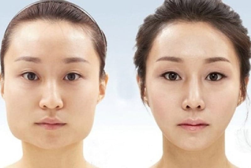 Phương pháp phẫu thuật gọt hàm