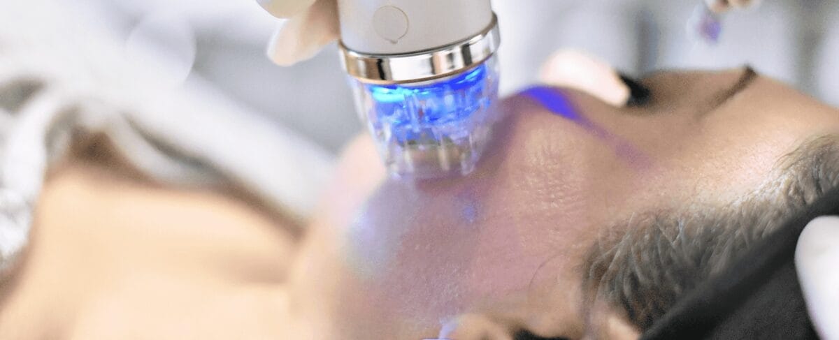 RF Microneedling là gì?