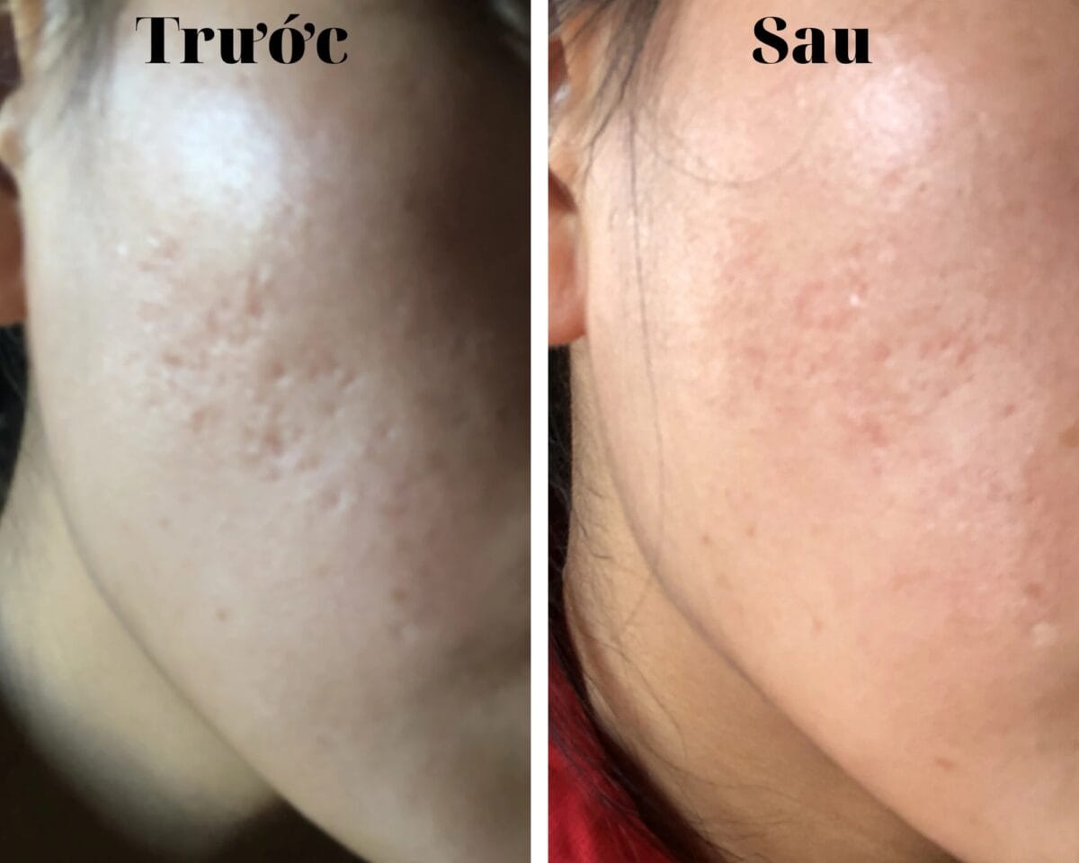 Sẹo lõm có tự đầy không?