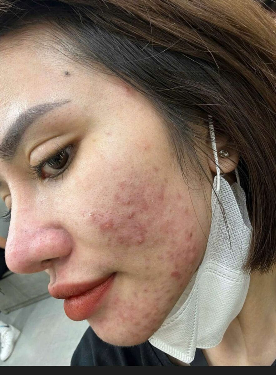 Sẹo lõm do mụn viêm gây ra