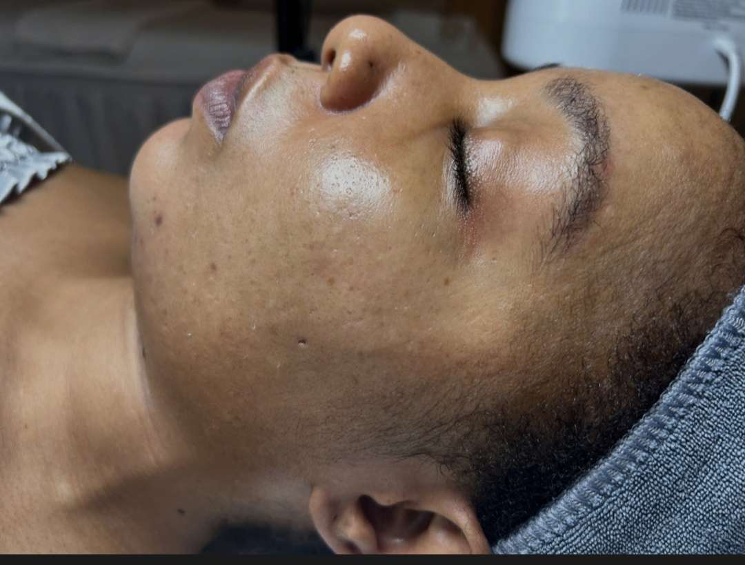 Sẹo lõm lâu năm là gì?