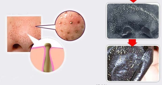 Sử dụng miếng dán mũi trị mụn đầu đen