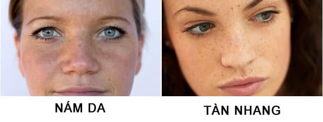 Tại sao cần phân biệt nám và tàn nhang?