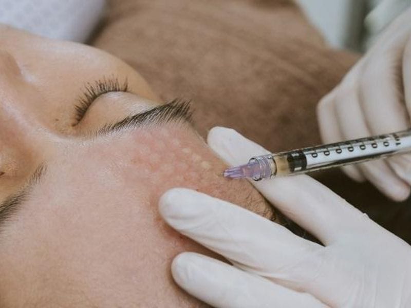 Tại sao cần tuân thủ chu trình tiêm meso