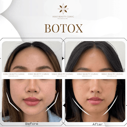 When Is It Safe to Sleep on Your Side After Botox Injections?
