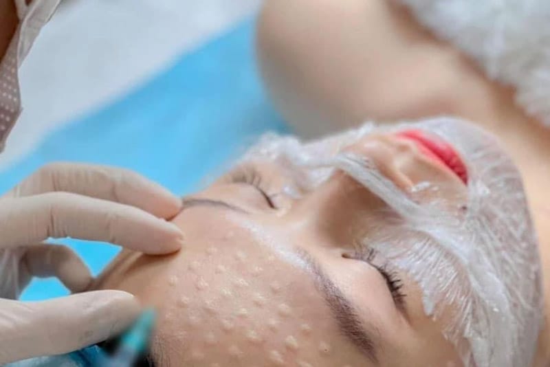 Tiêm meso bao nhiêu 1 lần là hợp lý