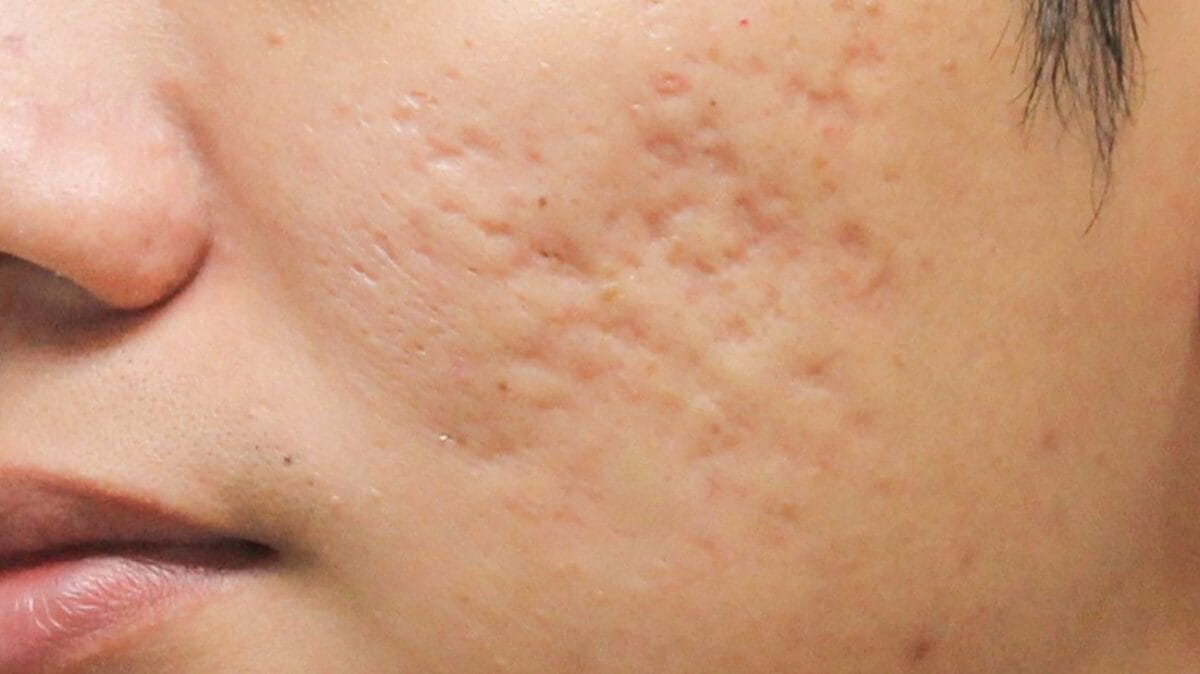 Condition of the scar