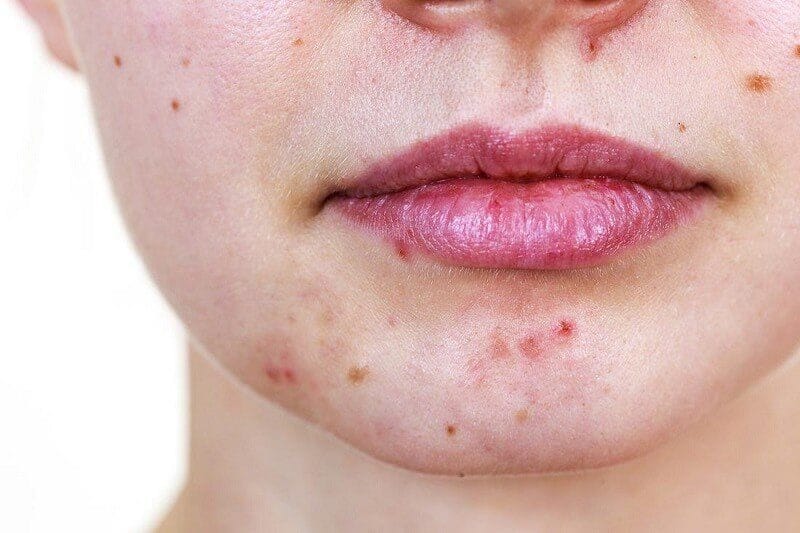 Tình trạng nổi mụn quanh miệng