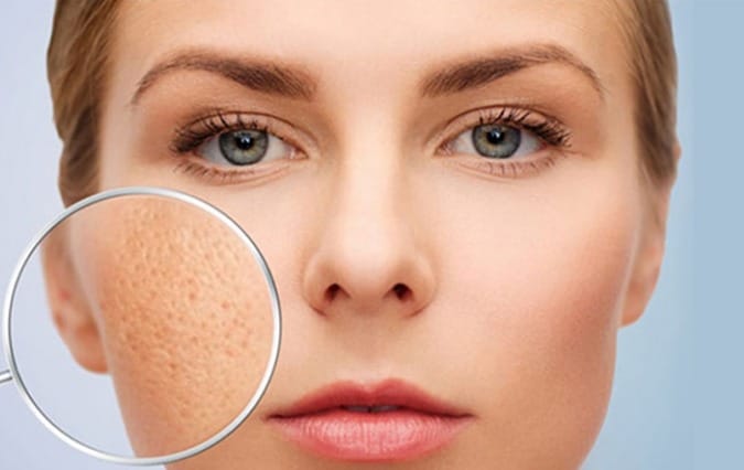 Pockmarks and concave scars appear on the skin surface.