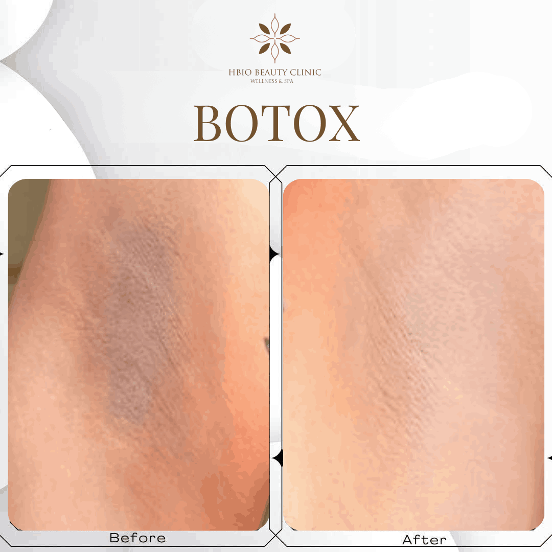 Simple At-Home Treatments for Underarm Wrinkles