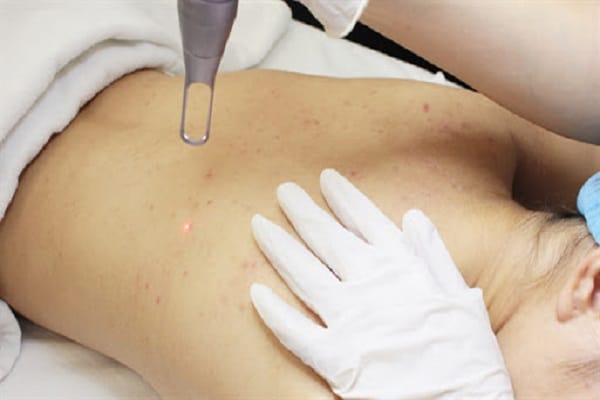 What is laser treatment for back acne?
