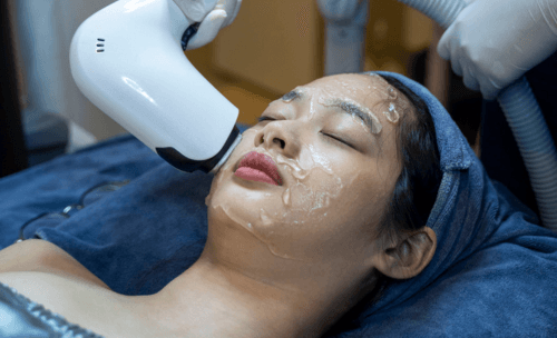 Triệt lông mặt bằng công nghệ Diode Laser tại HIBO Clinic