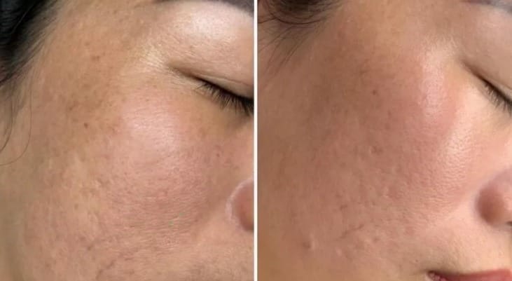 Before and after treating pitted scars at HBIO Clinic