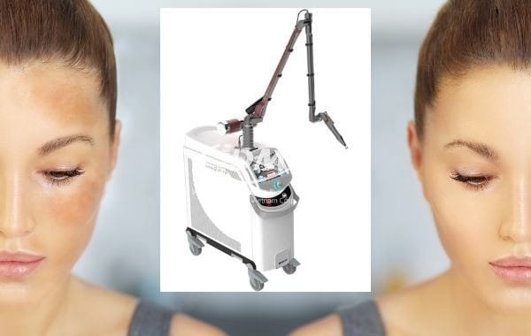 Ứng dụng của Laser ND YAG trong điều trị nám da