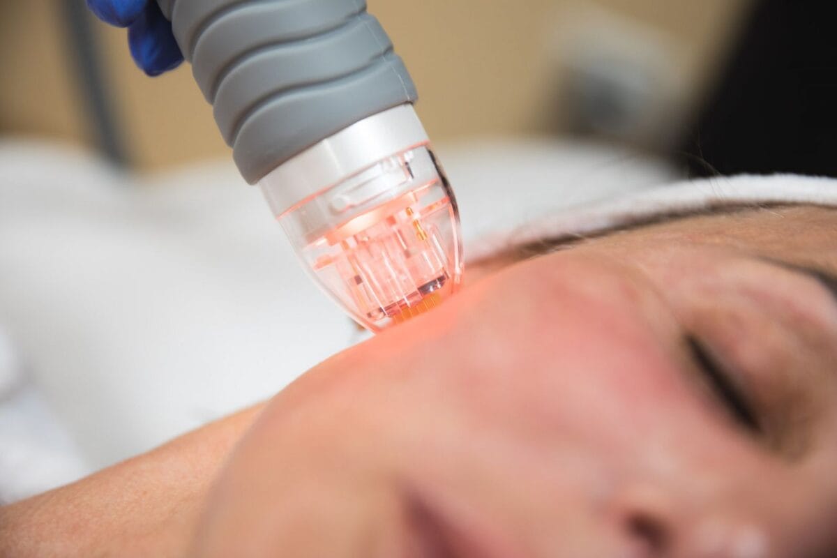 Ưu điểm nổi bật khi điều trị bằng RF microneedling