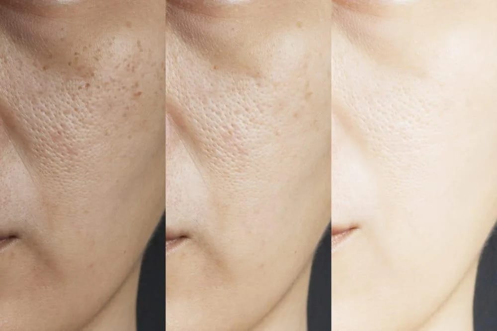 Ưu điểm khi trẻ hóa da bằng công nghệ cao tại HIBO Clinic