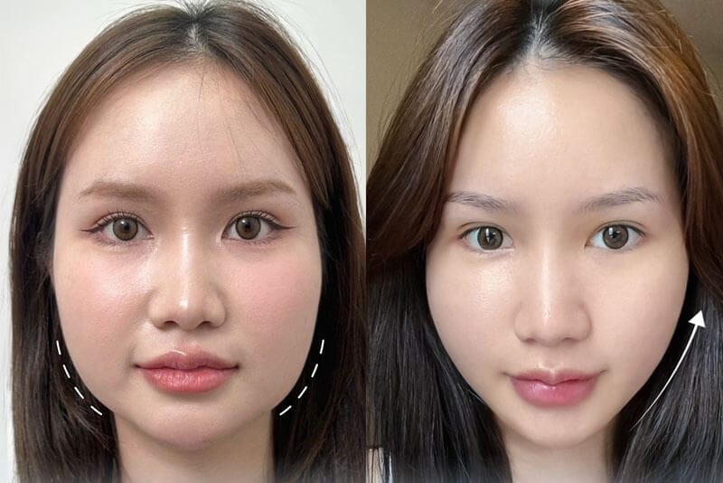 Botox gọn hàm là gì? 