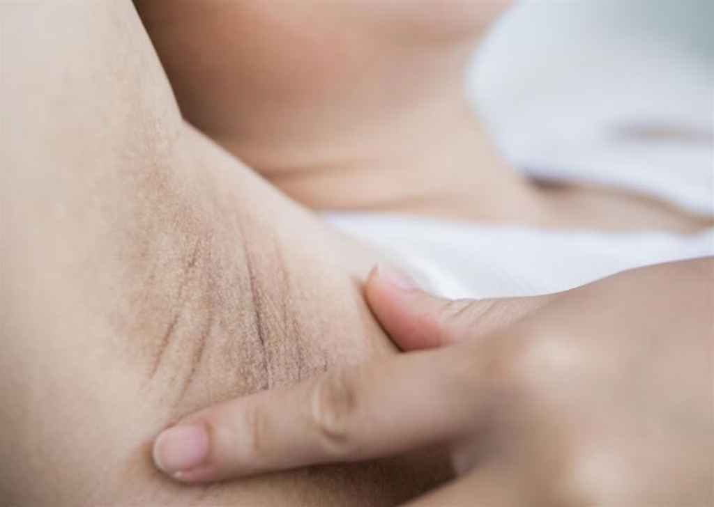 Các cách trị thâm nách sau sinh tại nhà hiệu quả
