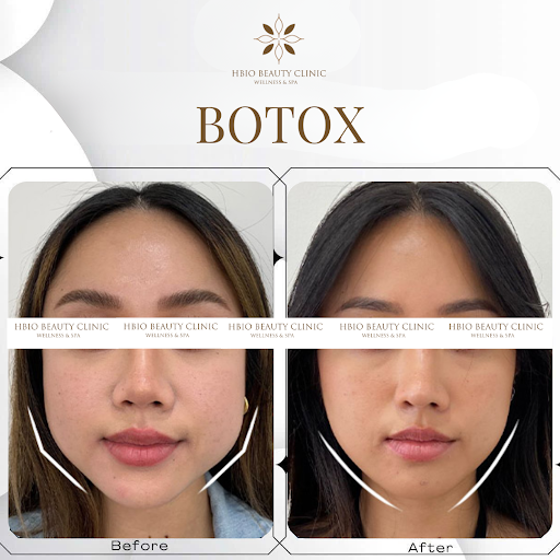 Botox gọn hàm là gì?