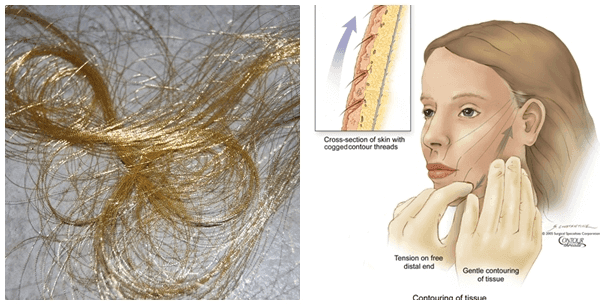 Popular types of nose lift threads today