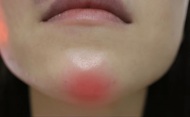 Cách giảm bầm tím sau khi tiêm filler dễ nhất