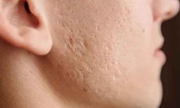 Cắt đáy sẹo là gì?