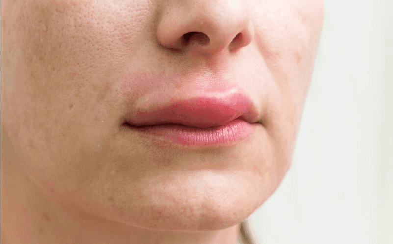 Cơ thể dị ứng muộn với thành phần filler