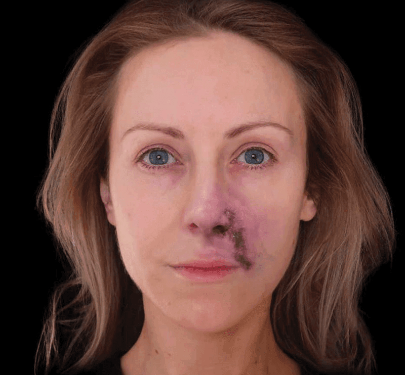 Signs of necrosis after nose filler injection