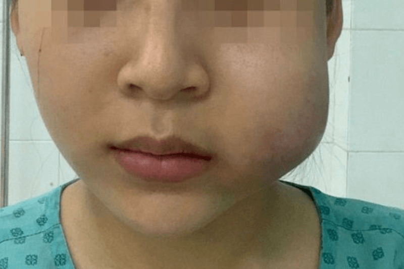 Dấu hiệu nhận biết tiêm filler bị sưng