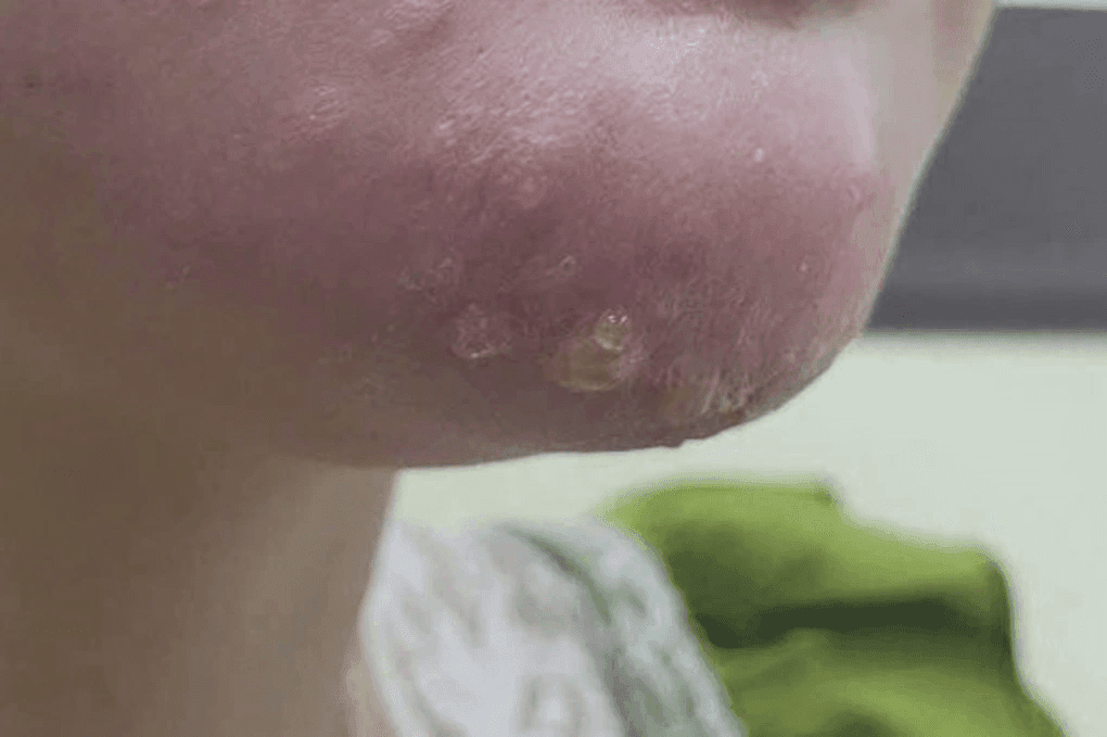 Signs of chin filler injection necrosis