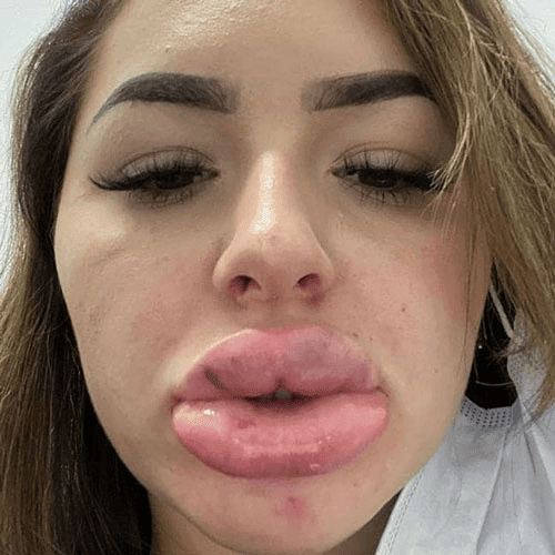 Signs of failed lip filler injection